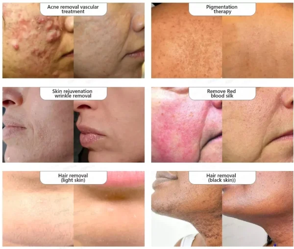 Professional Two In One DPL And Diode Laser Hair Removal Machine - Image 5