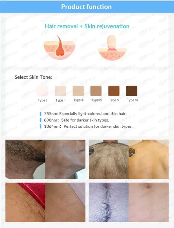 CE Approve Big Spot Professional Painless Diode Laser Hair Removal Portable Machine 808nm - Image 2