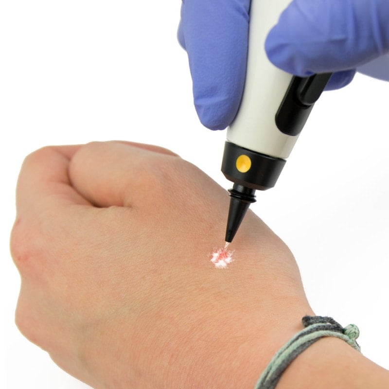 Φορητό Στυλό Κρυοπηξίας Cryopen X+ (Νέο Μοντέλο) - Image 5