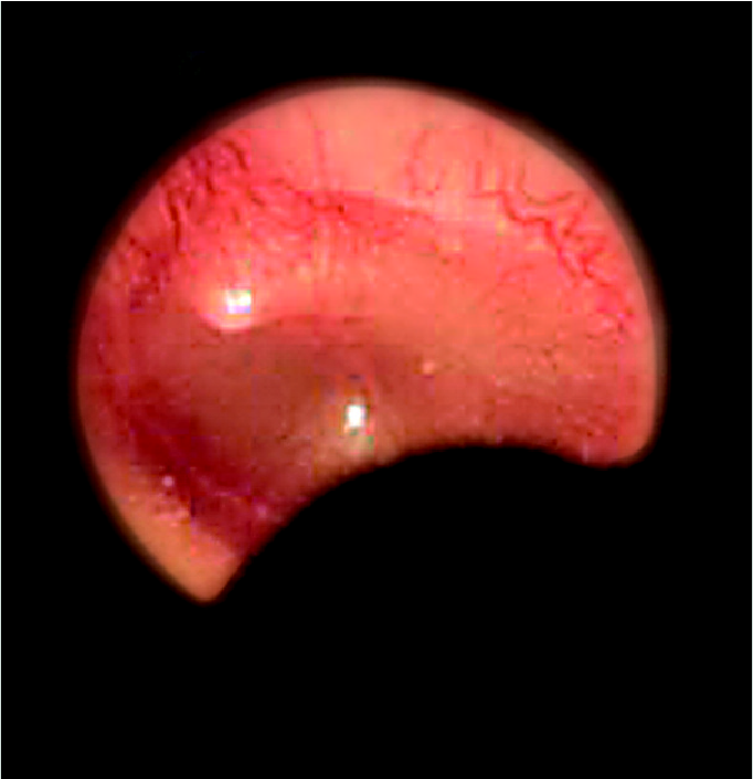 Ωτοσκόπιο Οπτικής Ίνας Heine BETA®200 με Λαμπτήρα 2.5V - Image 2