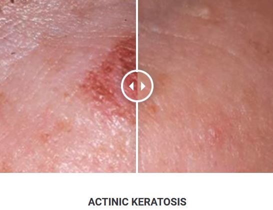 Φορητό Στυλό Κρυοπηξίας Cryopen X+ (Νέο Μοντέλο) - Image 27