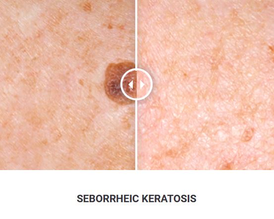 Φορητό Στυλό Κρυοπηξίας Cryopen X+ (Νέο Μοντέλο) - Image 21