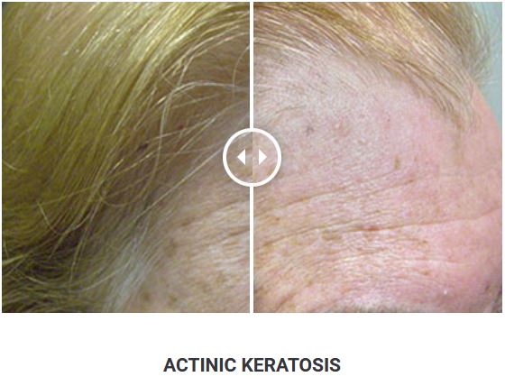 Φορητό Στυλό Κρυοπηξίας Cryopen X+ (Νέο Μοντέλο) - Image 18