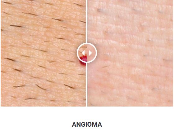 Φορητό Στυλό Κρυοπηξίας Cryopen X+ (Νέο Μοντέλο) - Image 19