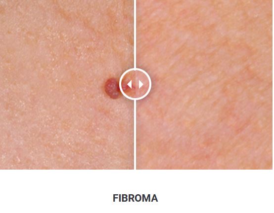 Φορητό Στυλό Κρυοπηξίας Cryopen X+ (Νέο Μοντέλο) - Image 23