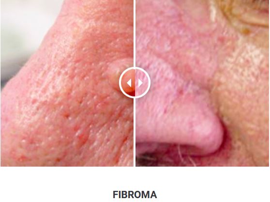 Φορητό Στυλό Κρυοπηξίας Cryopen X+ (Νέο Μοντέλο) - Image 13