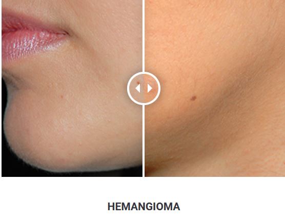 Φορητό Στυλό Κρυοπηξίας Cryopen X+ (Νέο Μοντέλο) - Image 26