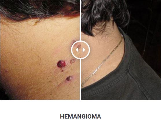 Φορητό Στυλό Κρυοπηξίας Cryopen X+ (Νέο Μοντέλο) - Image 16