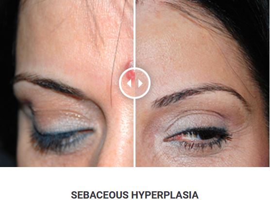 Φορητό Στυλό Κρυοπηξίας Cryopen X+ (Νέο Μοντέλο) - Image 14