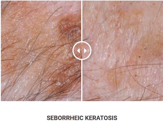 Φορητό Στυλό Κρυοπηξίας Cryopen X+ (Νέο Μοντέλο) - Image 20