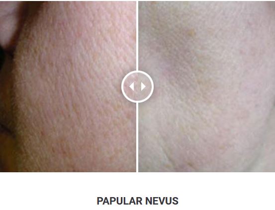 Φορητό Στυλό Κρυοπηξίας Cryopen X+ (Νέο Μοντέλο) - Image 17