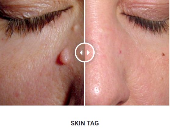 Φορητό Στυλό Κρυοπηξίας Cryopen X+ (Νέο Μοντέλο) - Image 11