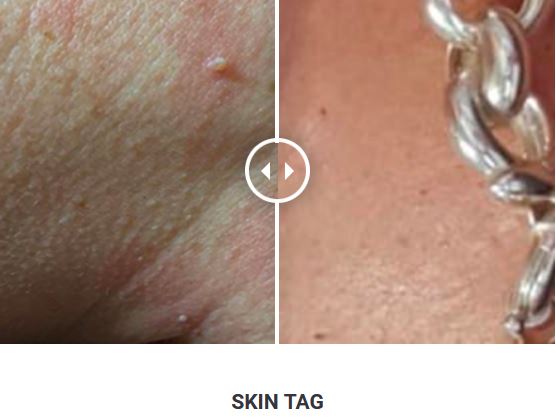 Φορητό Στυλό Κρυοπηξίας Cryopen X+ (Νέο Μοντέλο) - Image 15