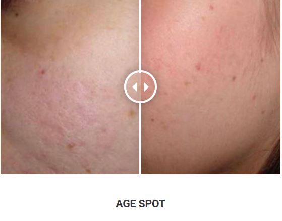 Φορητό Στυλό Κρυοπηξίας Cryopen X+ (Νέο Μοντέλο) - Image 22