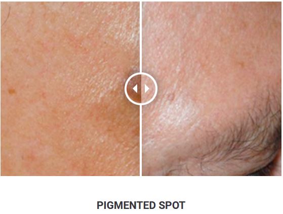 Φορητό Στυλό Κρυοπηξίας Cryopen X+ (Νέο Μοντέλο) - Image 25