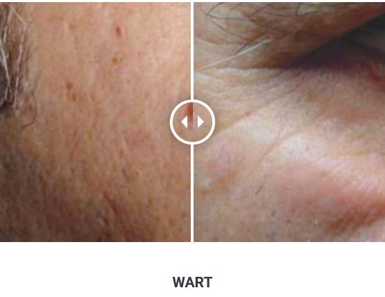 Φορητό Στυλό Κρυοπηξίας Cryopen X+ (Νέο Μοντέλο) - Image 24