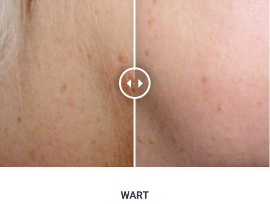 Φορητό Στυλό Κρυοπηξίας Cryopen X+ (Νέο Μοντέλο) - Image 12